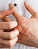 Dry Skin Eczema Hands